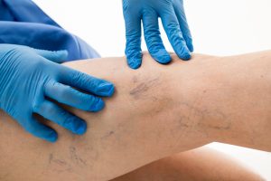 varicose veins 2 5