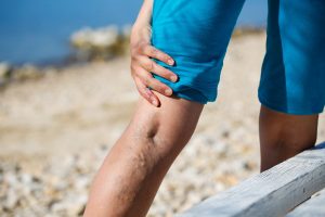 varicose veins 5