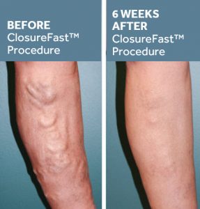 ClosureFast Procedure Before and After Pictures 1