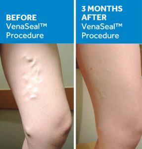 Before and After VenaSeal Closure System 1