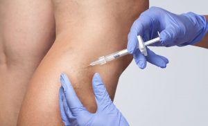 Spider Veins, Sclerotherapy